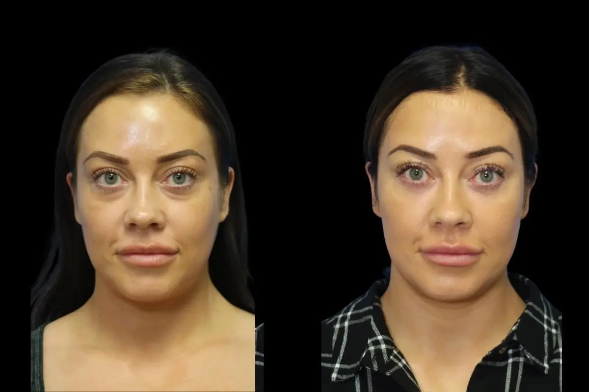 Blepharoplasty: Patient 2 - Before and After  