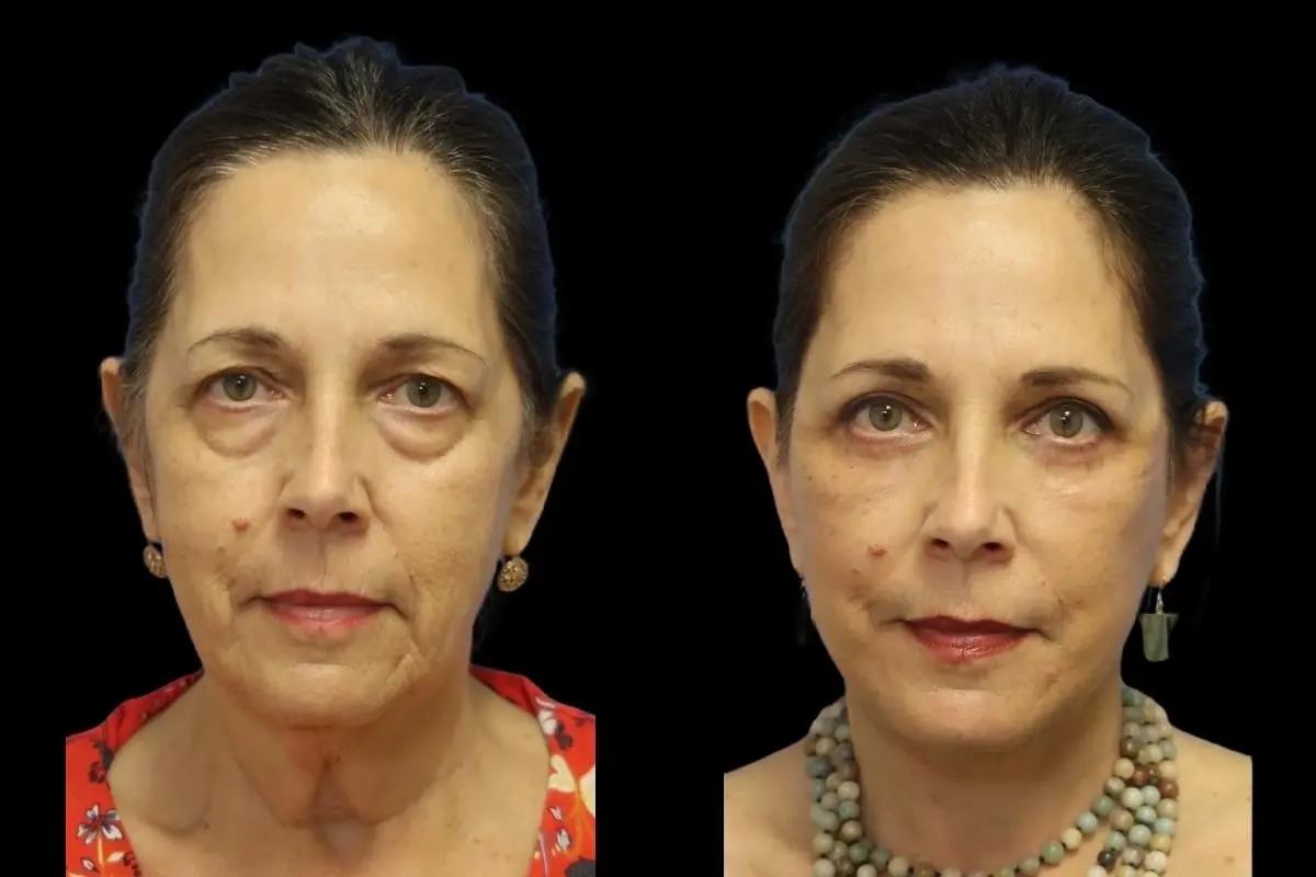 Blepharoplasty: Patient 3 - Before and After  