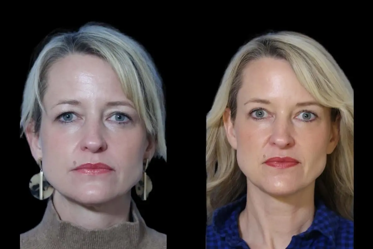 Blepharoplasty: Patient 10 - Before and After  