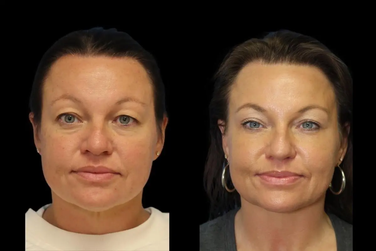 Blepharoplasty: Patient 1 - Before and After  