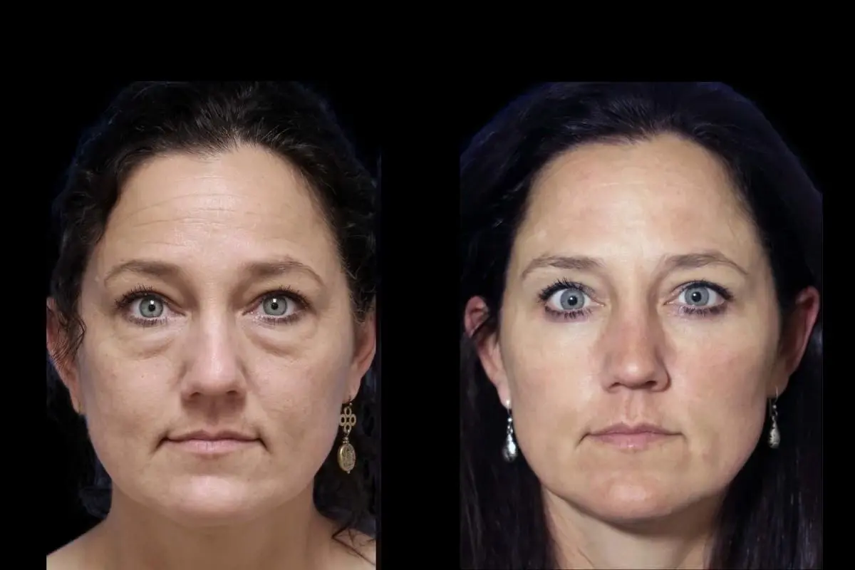 Blepharoplasty: Patient 9 - Before and After  