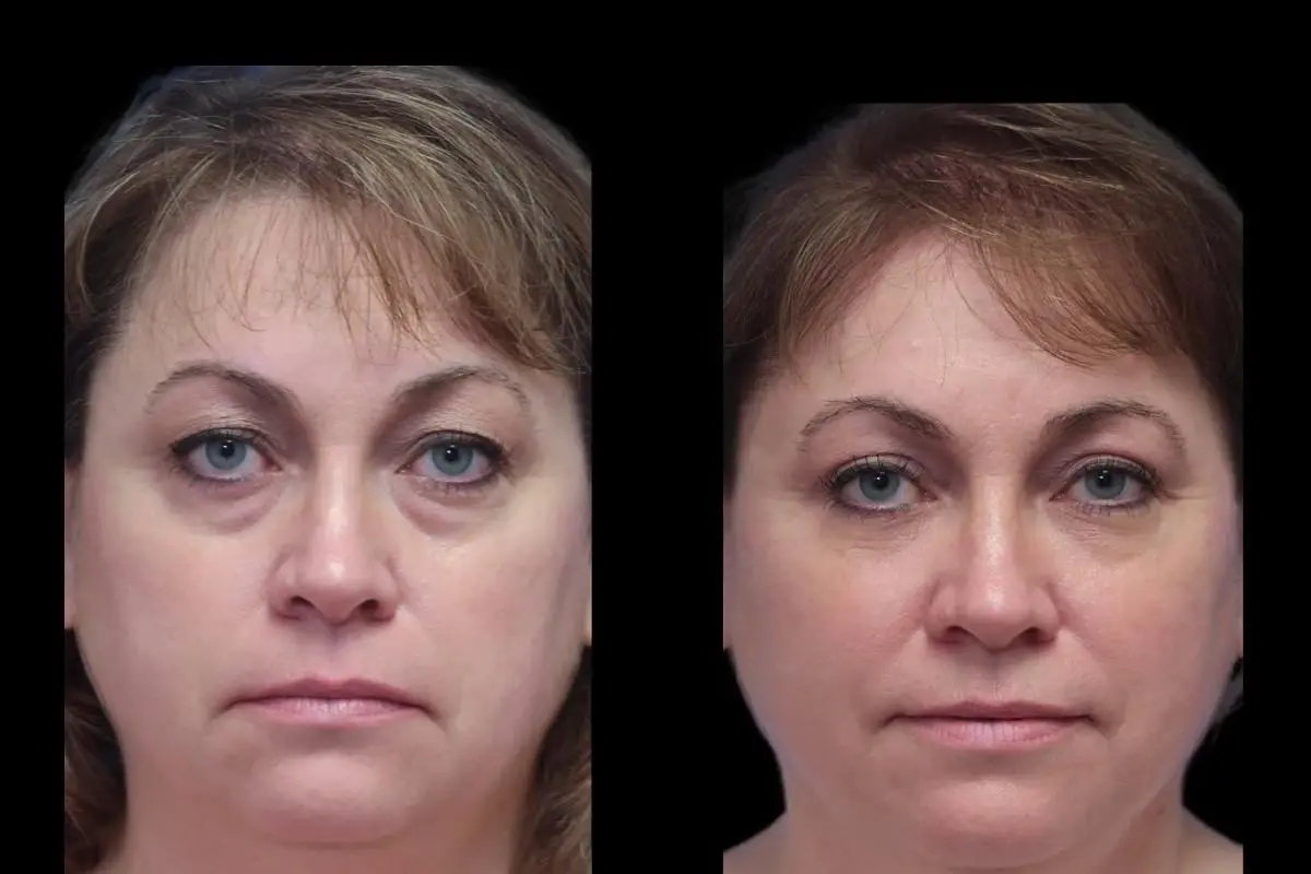 Blepharoplasty: Patient 8 - Before and After  