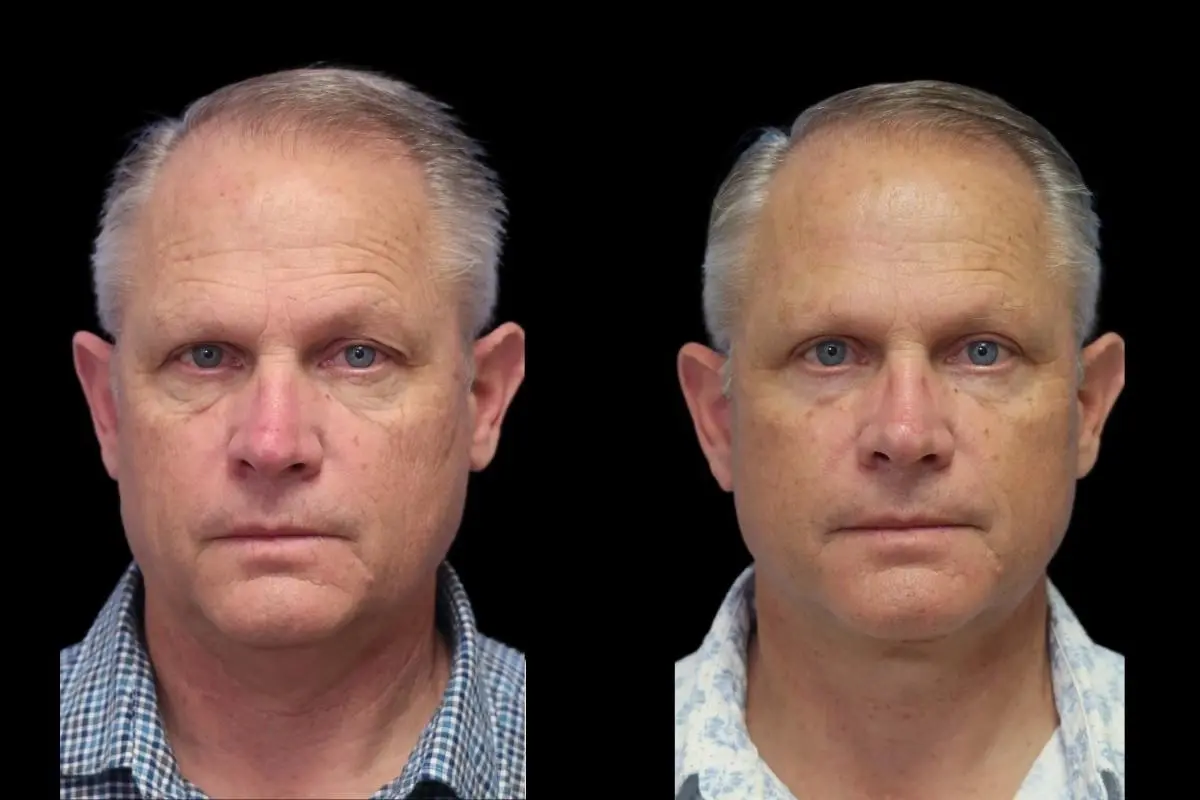 Blepharoplasty: Patient 6 - Before and After  