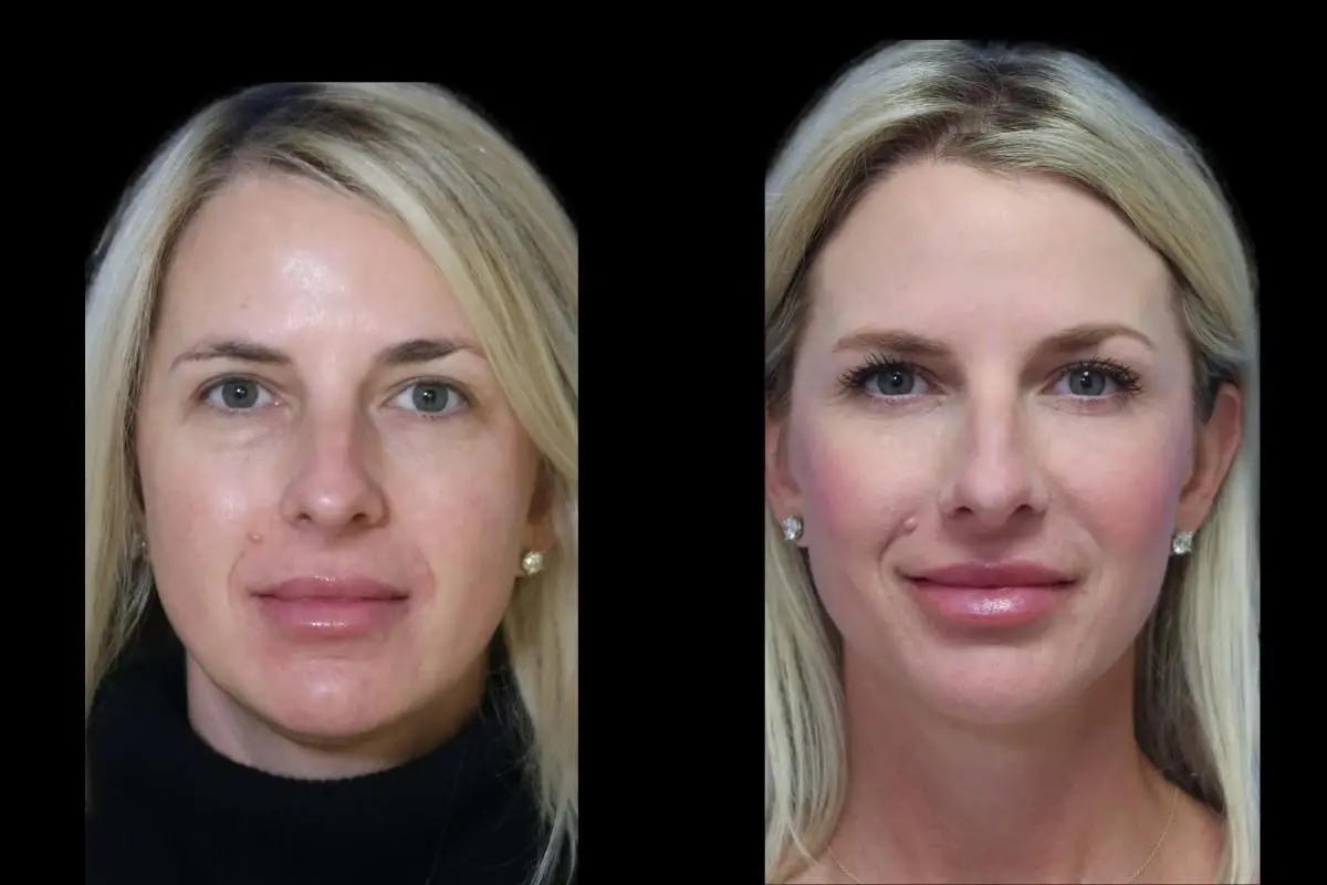 Blepharoplasty: Patient 7 - Before and After  