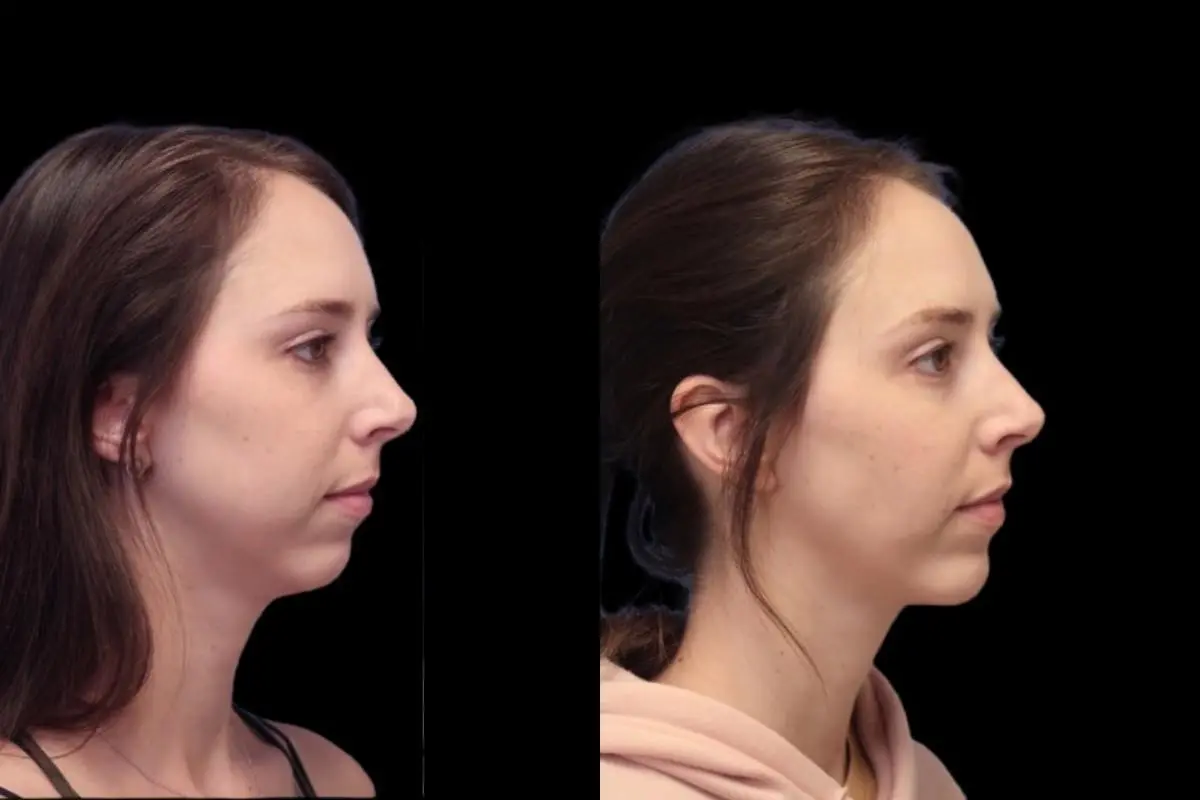 Chin Augmentation: Patient 3 - Before and After  