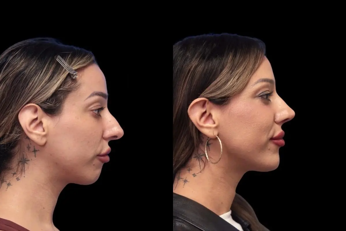 Chin Augmentation: Patient 1 - Before and After  