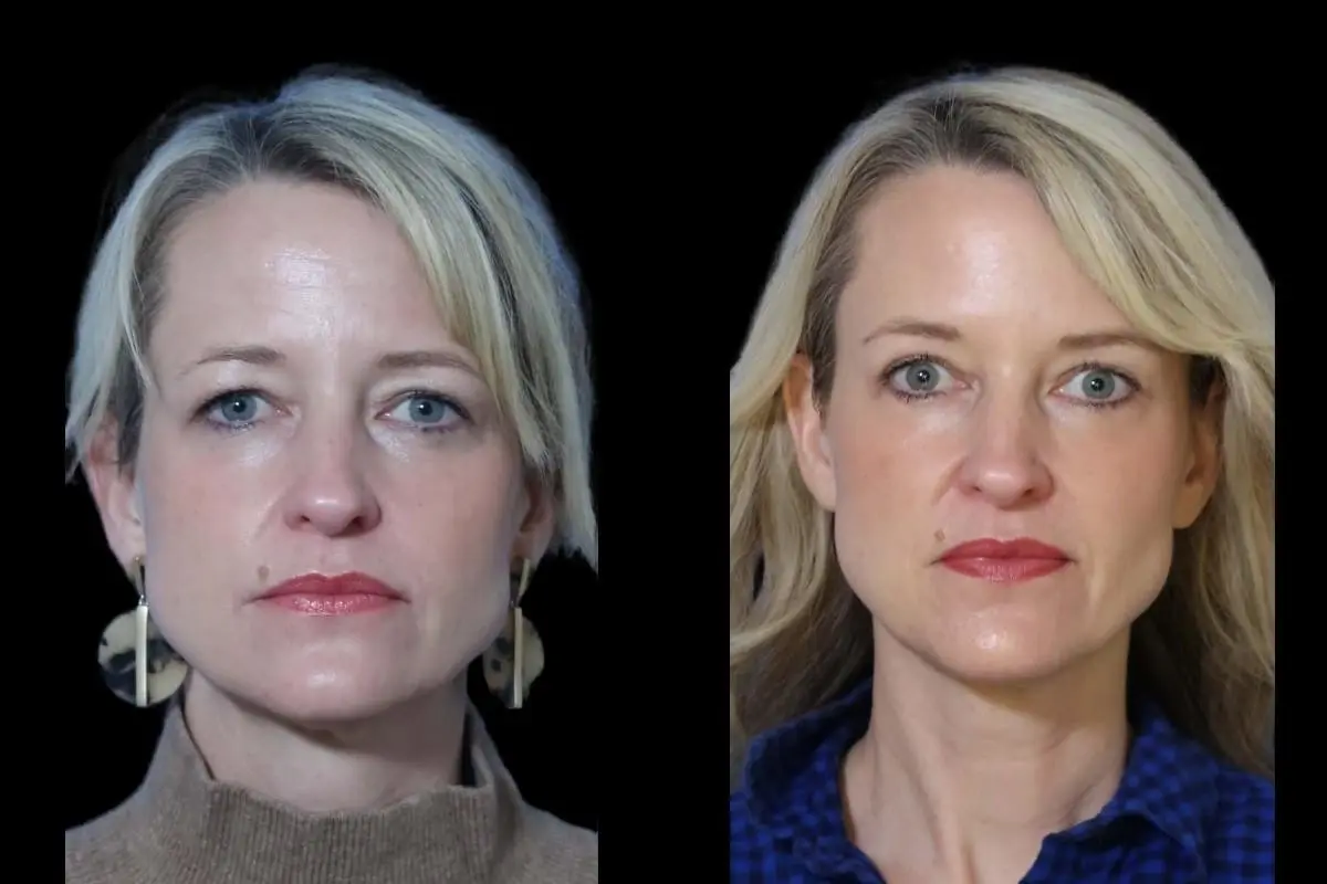 Endoscopic Brow Lift: Patient 1 - Before and After  