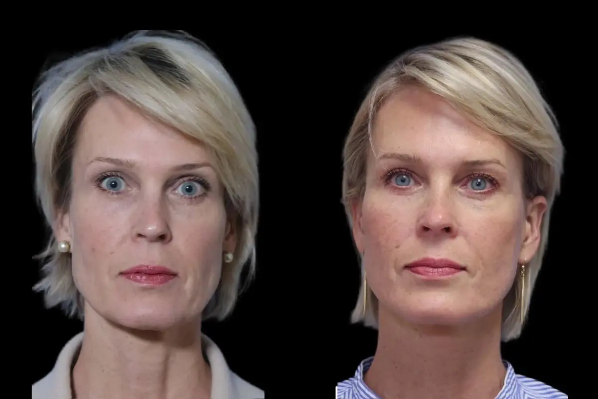 Facelift: Patient 10 - Before and After  