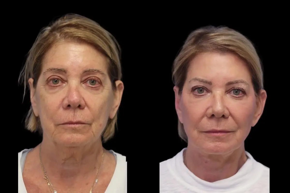 Facelift: Patient 5 - Before and After  