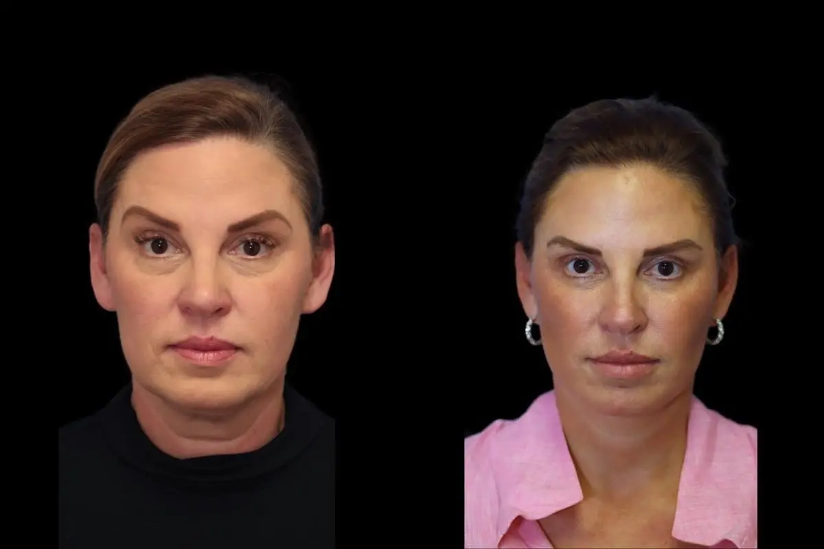 Facelift: Patient 1 - Before and After  