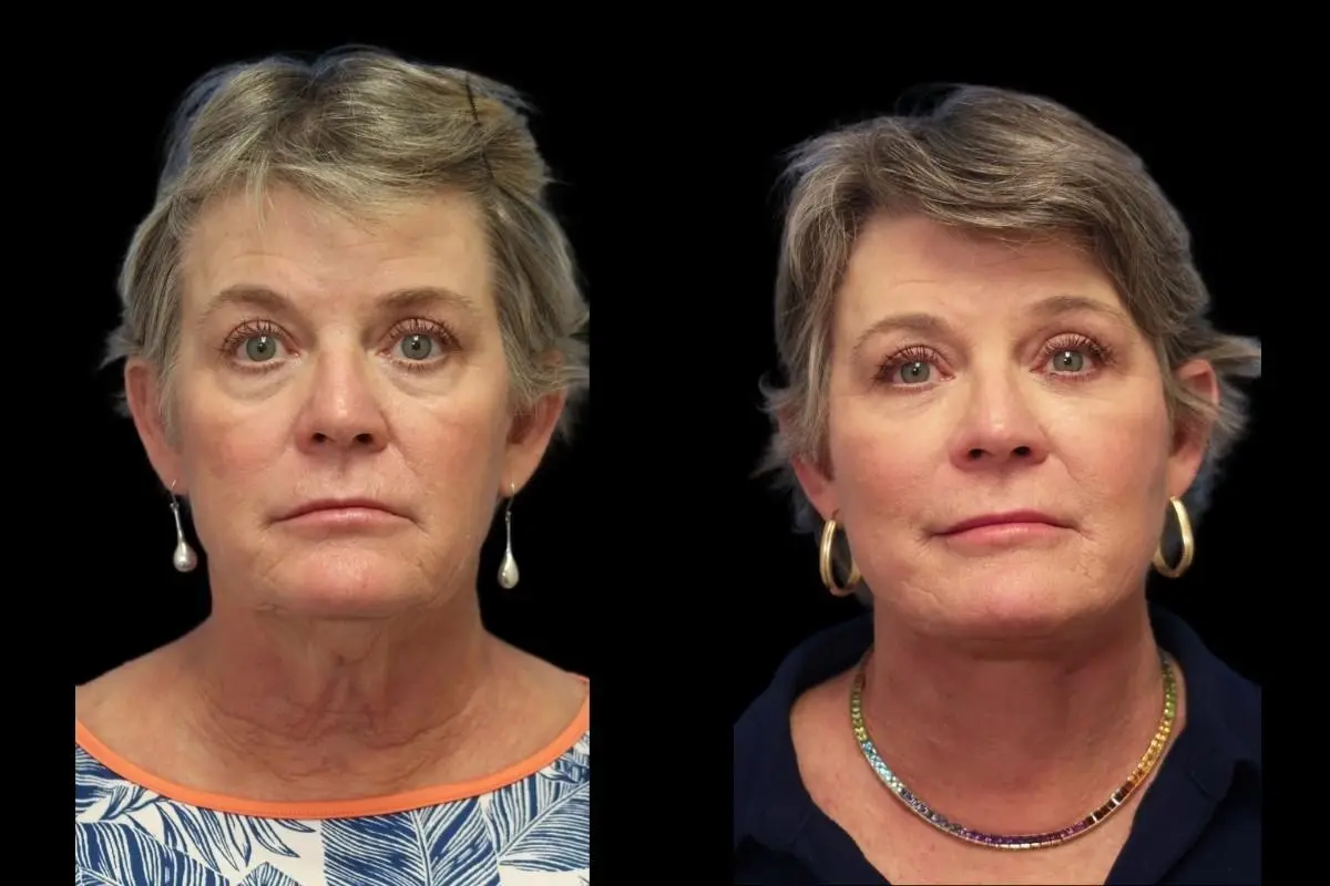 Facelift: Patient 8 - Before and After  