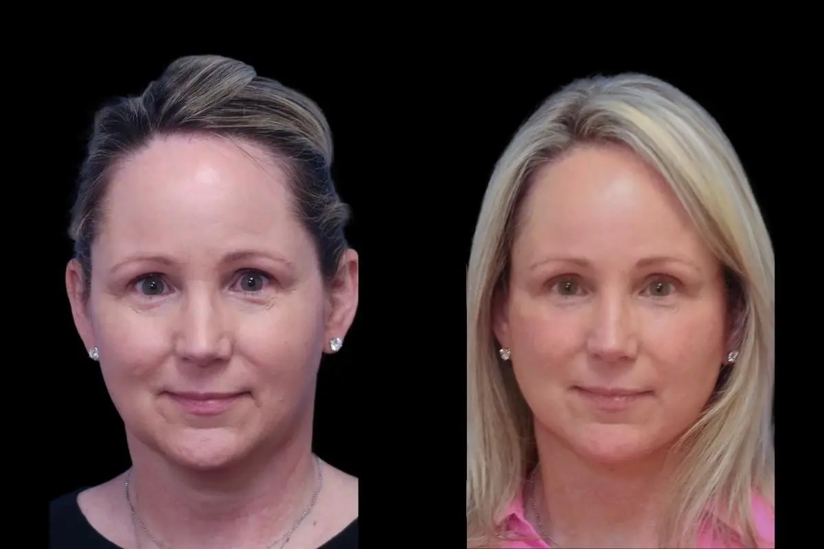 Facelift: Patient 6 - Before and After  