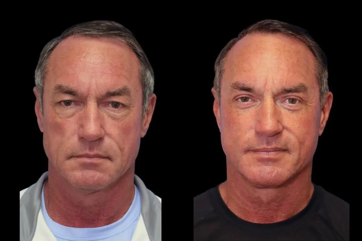 Facelift: Patient 3 - Before and After  