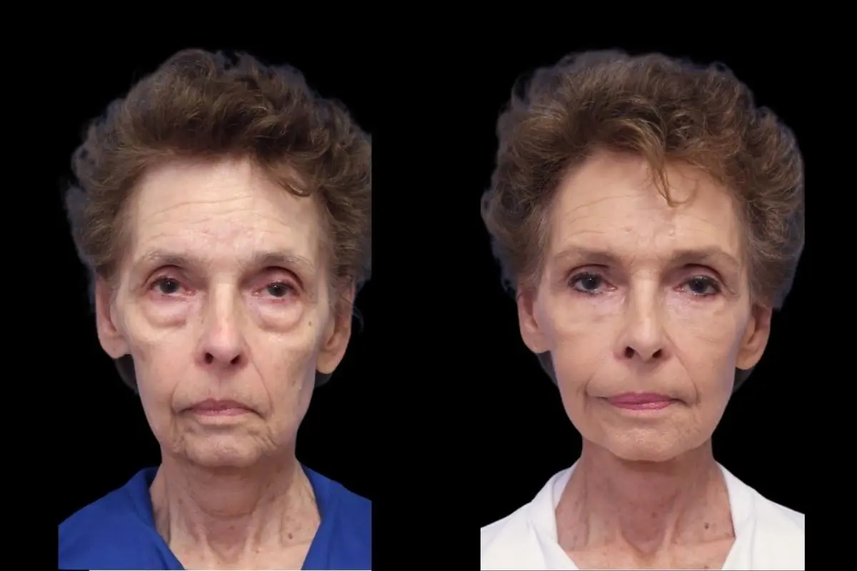 Facelift: Patient 7 - Before and After  