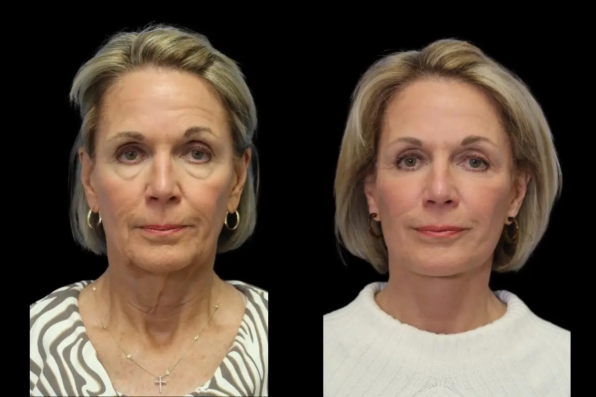 Facelift: Patient 4 - Before and After  