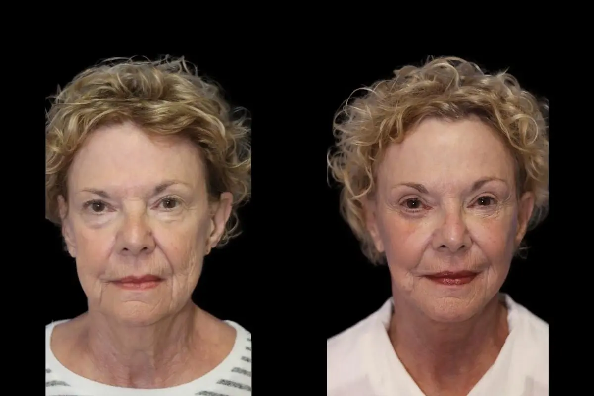 Facelift: Patient 2 - Before and After  