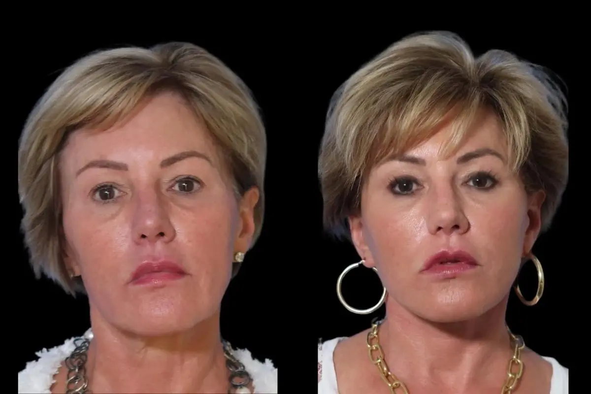 Facelift: Patient 9 - Before and After  