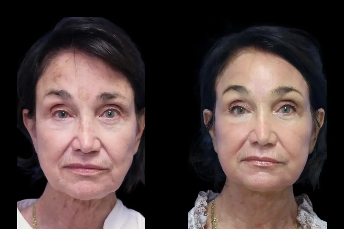 Laser Skin Resurfacing: Patient 1 - Before and After  