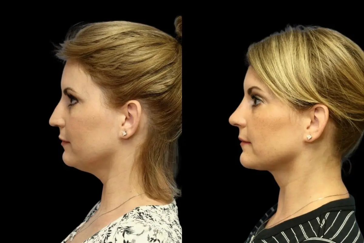 Neck Lift: Patient 2 - Before and After  