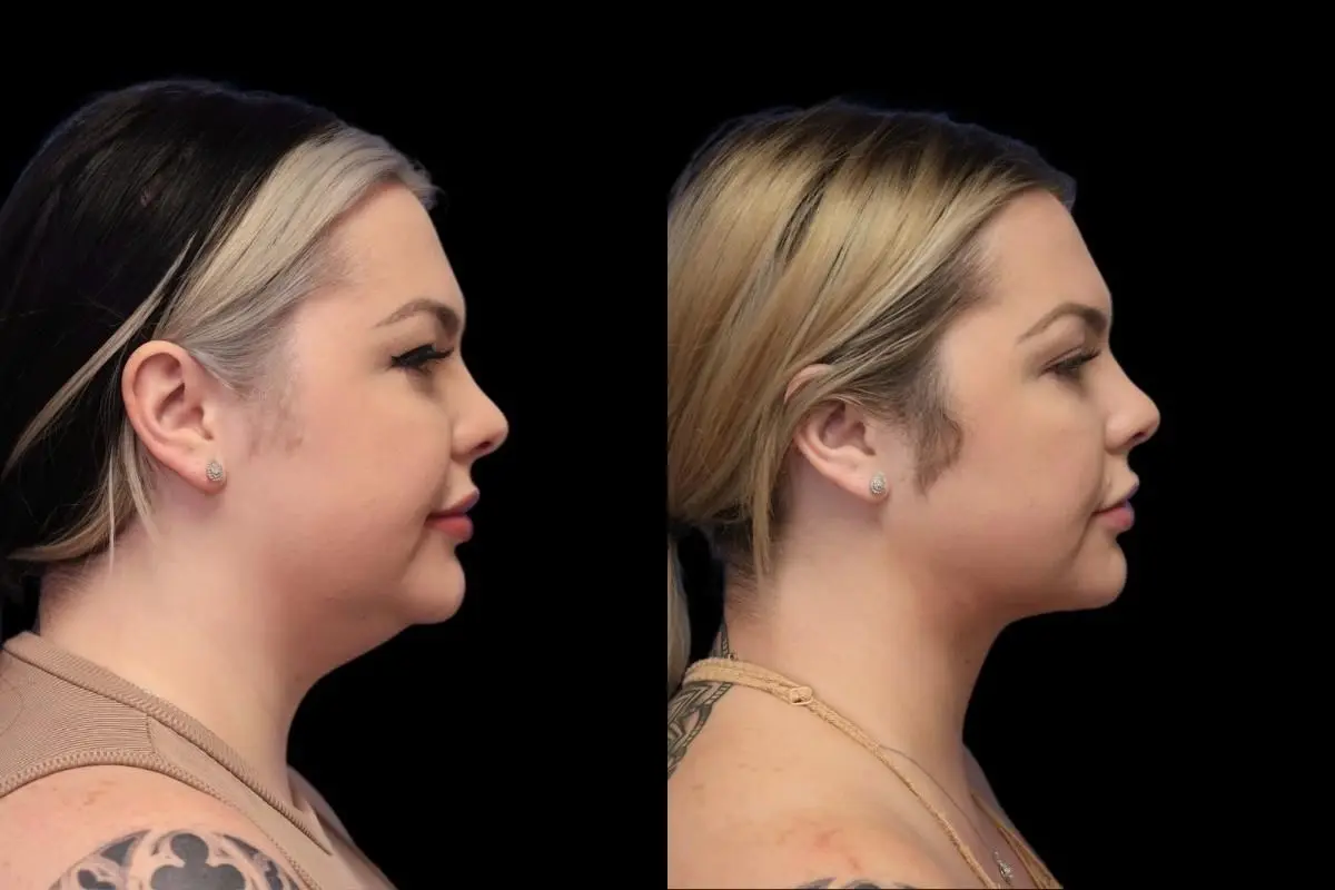 Neck Lift: Patient 1 - Before and After  