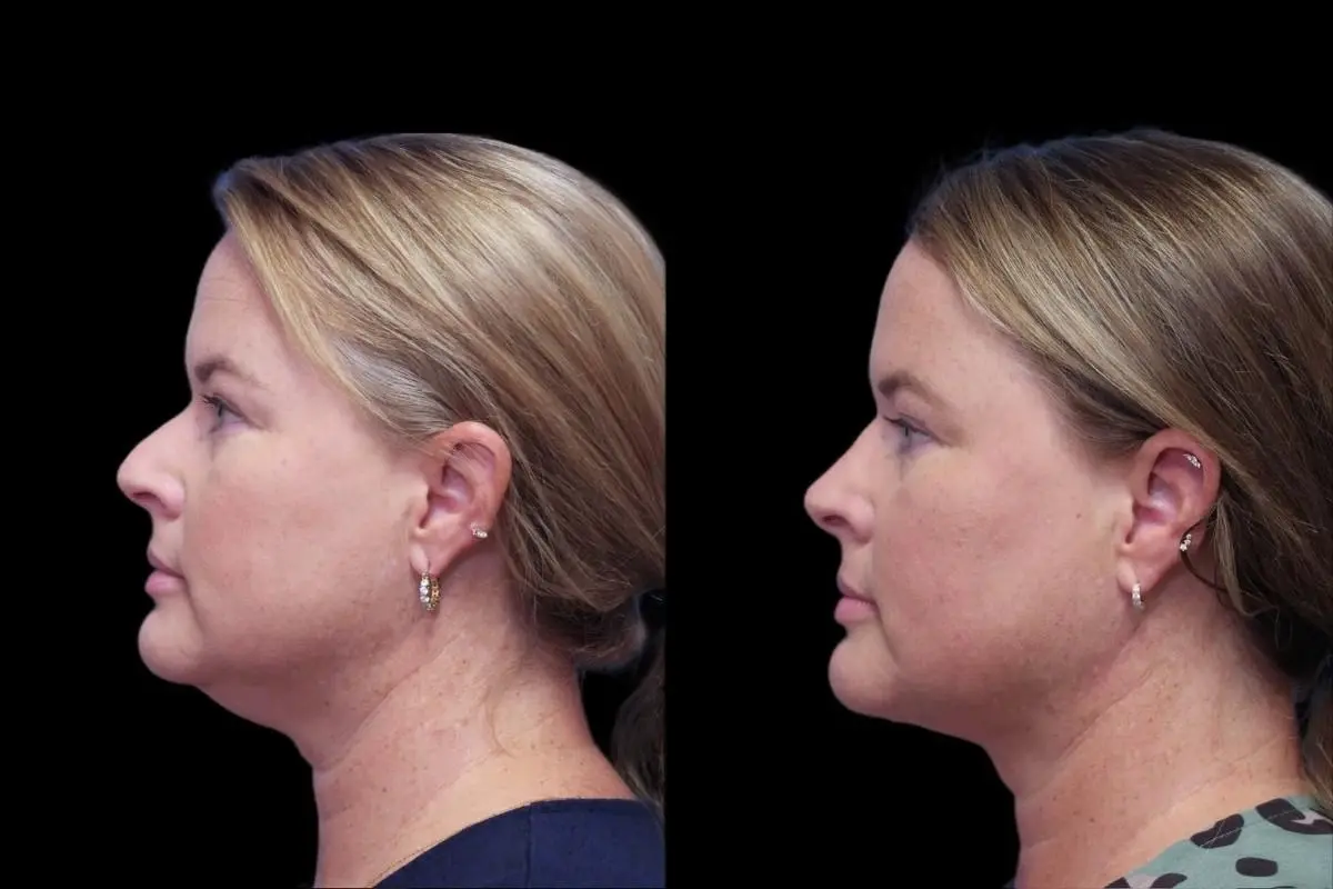 Neck Lift: Patient 3 - Before and After  