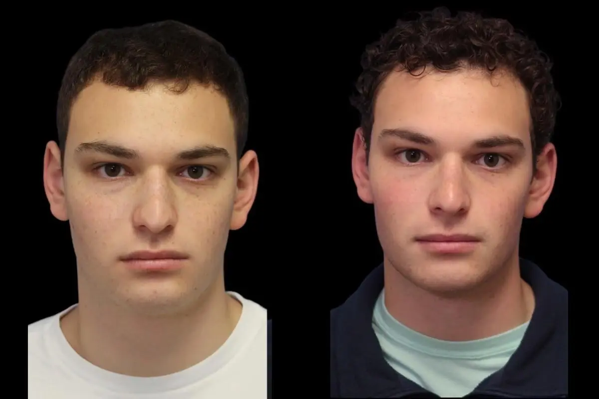 Rhinoplasty: Patient 7 - Before and After  