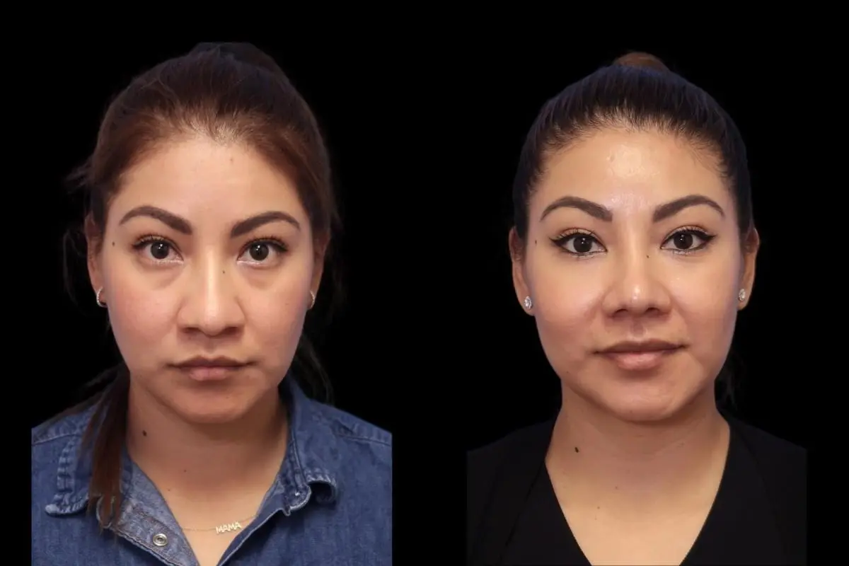 Rhinoplasty: Patient 1 - Before and After  