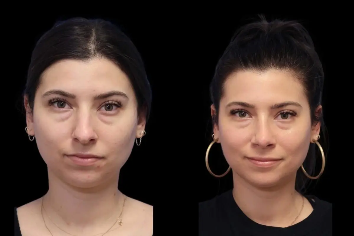 Rhinoplasty: Patient 2 - Before and After  