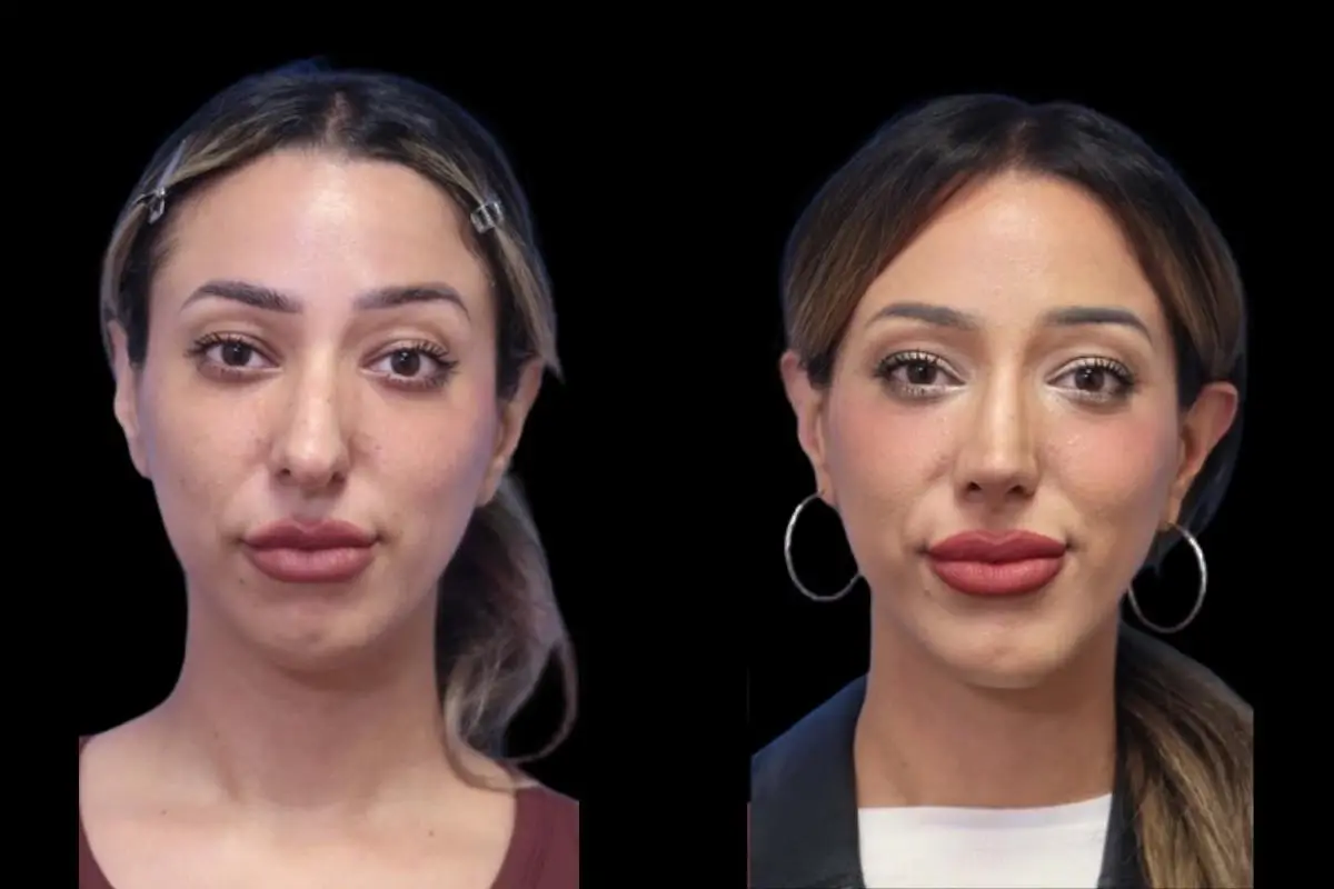 Rhinoplasty: Patient 5 - Before and After  