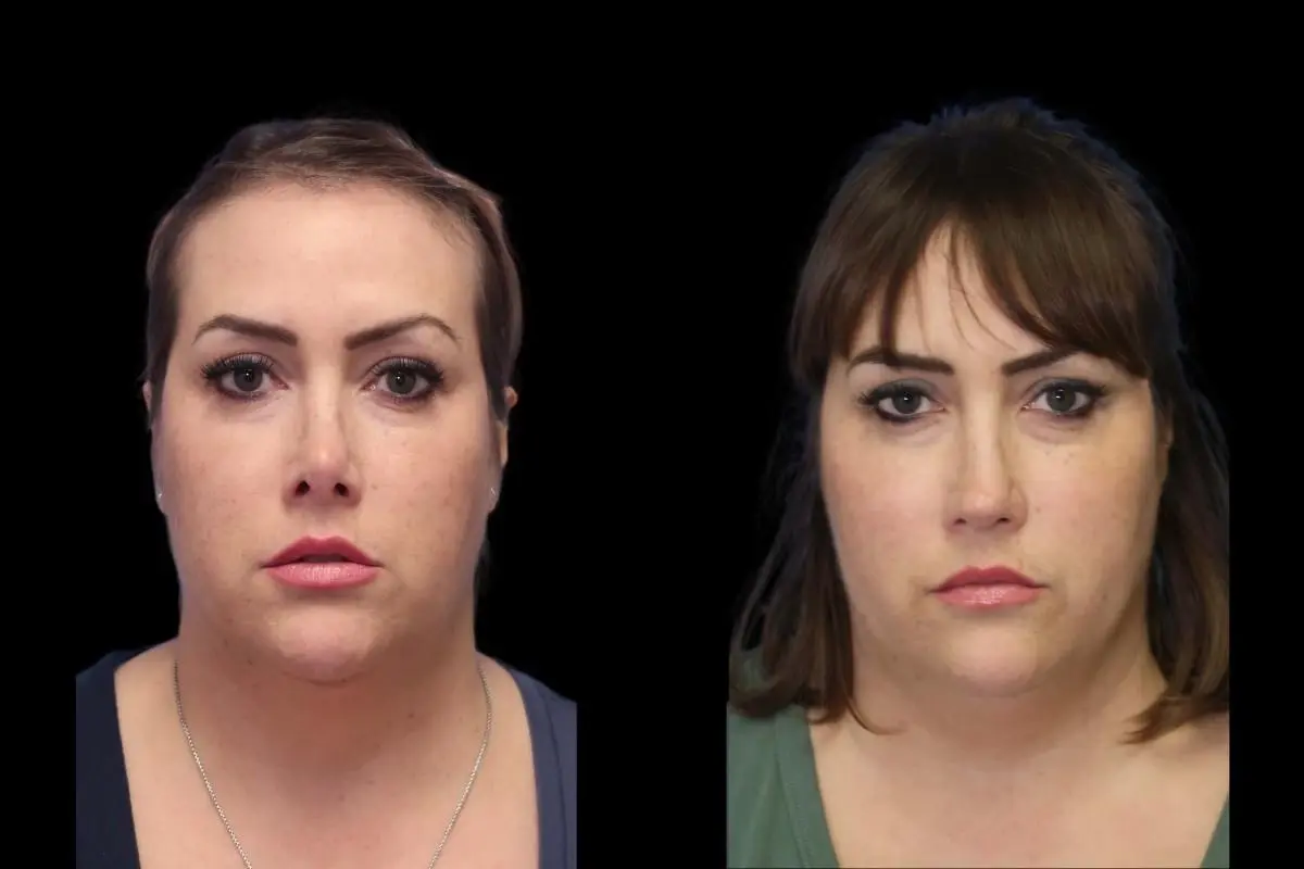 Rhinoplasty: Patient 4 - Before and After  