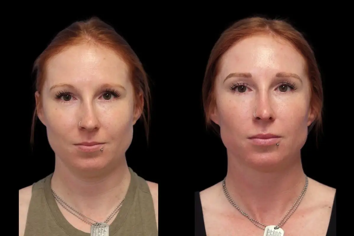 Rhinoplasty: Patient 3 - Before and After  