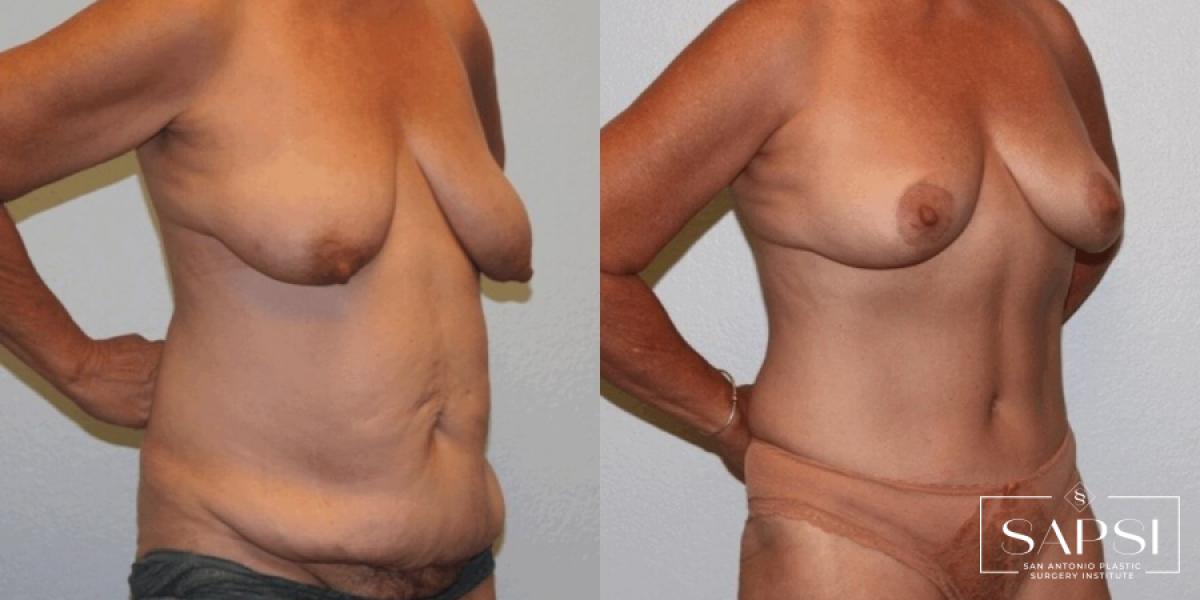 Breast Lift: Patient 11 - Before and After 2