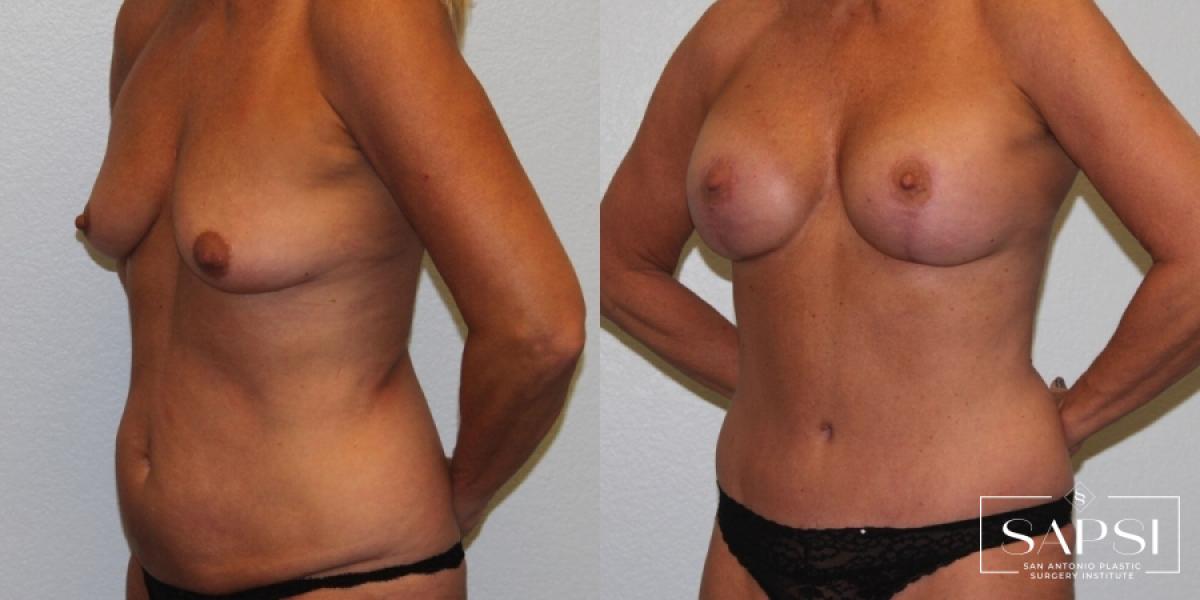 Breast Lift: Patient 7 - Before and After 2