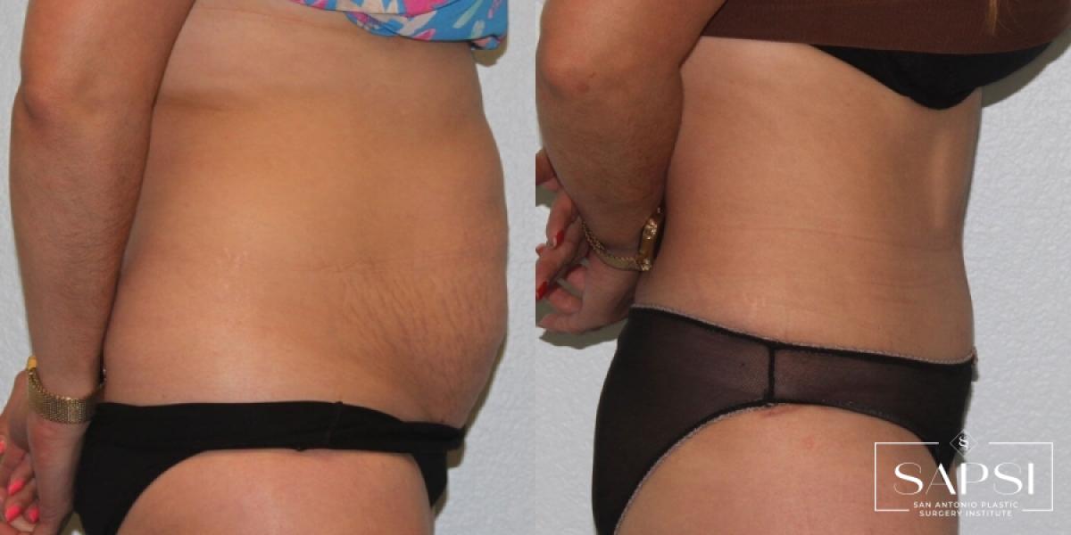 Body Contouring: Patient 4 - Before and After 3