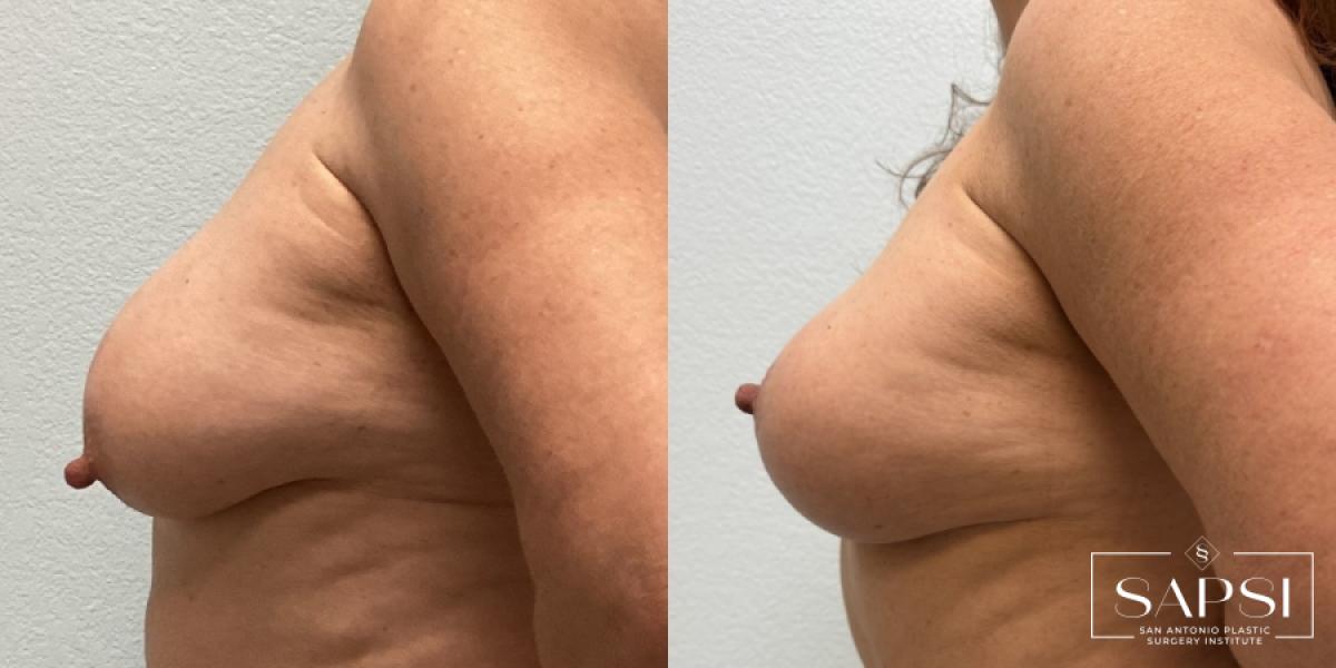 Breast Reduction: Patient 6 - Before and After 3