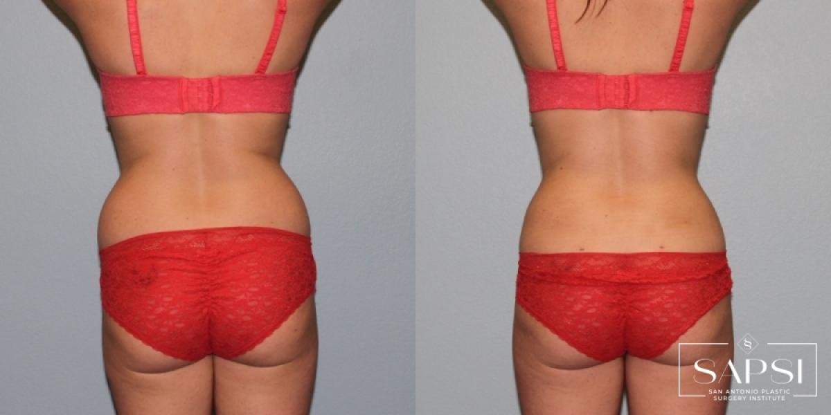 Body Contouring: Patient 1 - Before and After 3