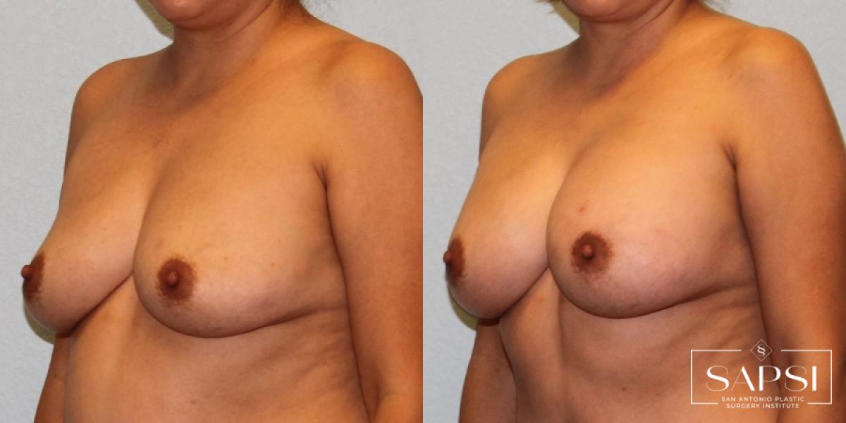 Breast Augmentation: Patient 78 - Before and After 2