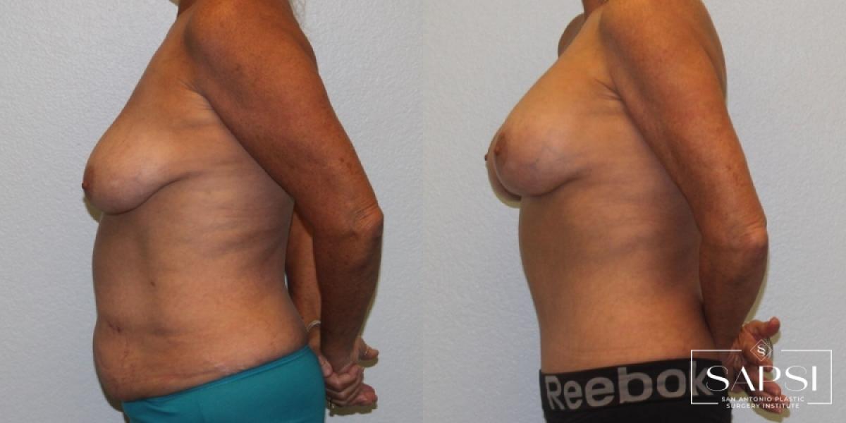 Breast Lift: Patient 8 - Before and After 3