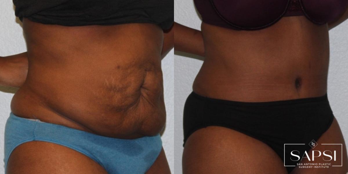 Tummy Tuck: Patient 25 - Before and After 2