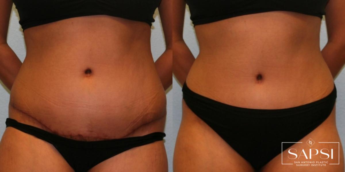 Tummy Tuck: Patient 15 - Before and After 4