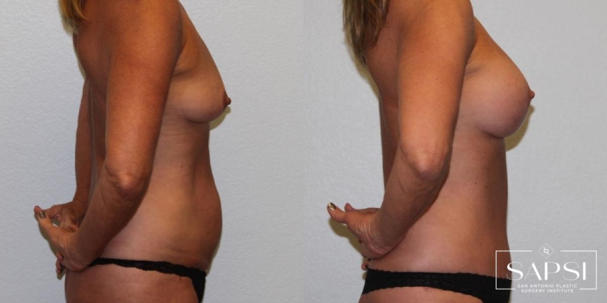 Breast Augmentation: Patient 63 - Before and After 3