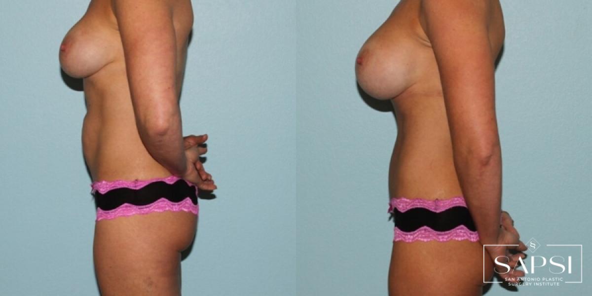 Breast Revision: Patient 10 - Before and After 3