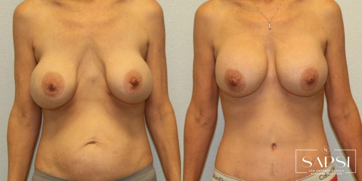 Breast Revision: Patient 2 - Before and After  