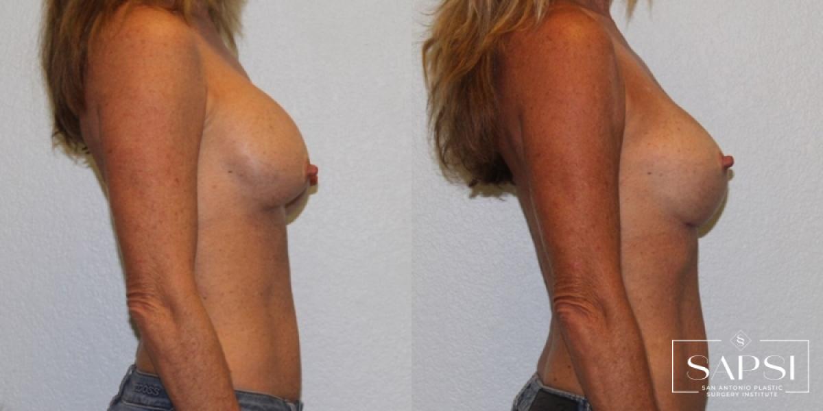 Breast Revision: Patient 7 - Before and After 3