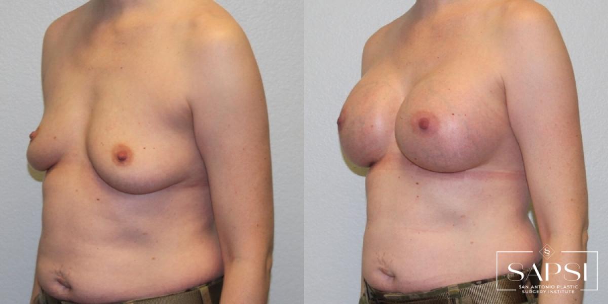 Breast Augmentation: Patient 31 - Before and After 2