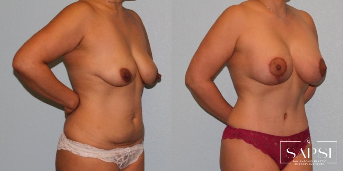 Breast Augmentation With Lift: Patient 7 - Before and After 2