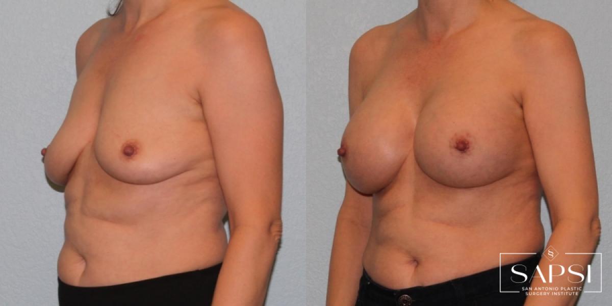 Breast Augmentation: Patient 14 - Before and After 2