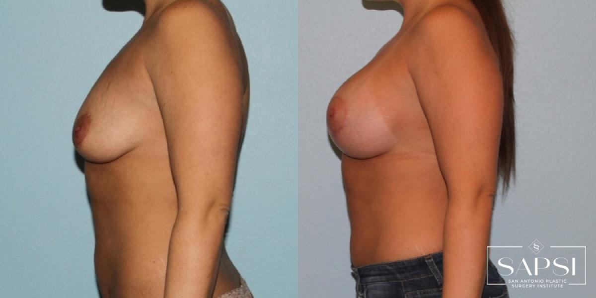 Breast Augmentation With Lift: Patient 21 - Before and After 3