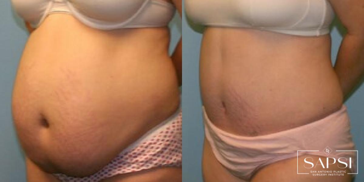 Tummy Tuck: Patient 38 - Before and After 2