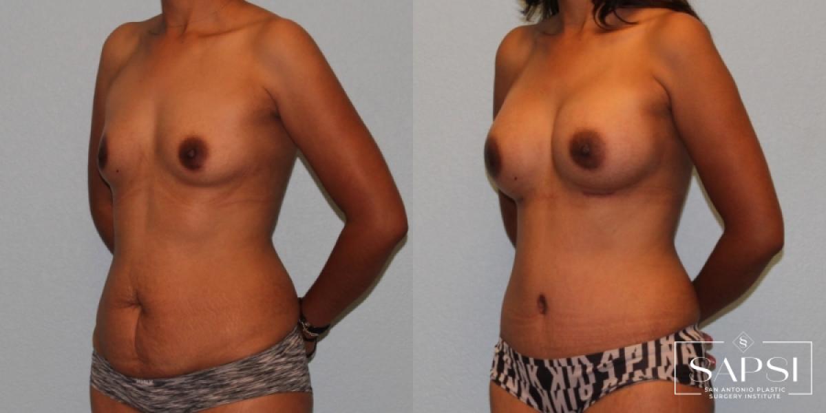 Breast Augmentation: Patient 72 - Before and After 2